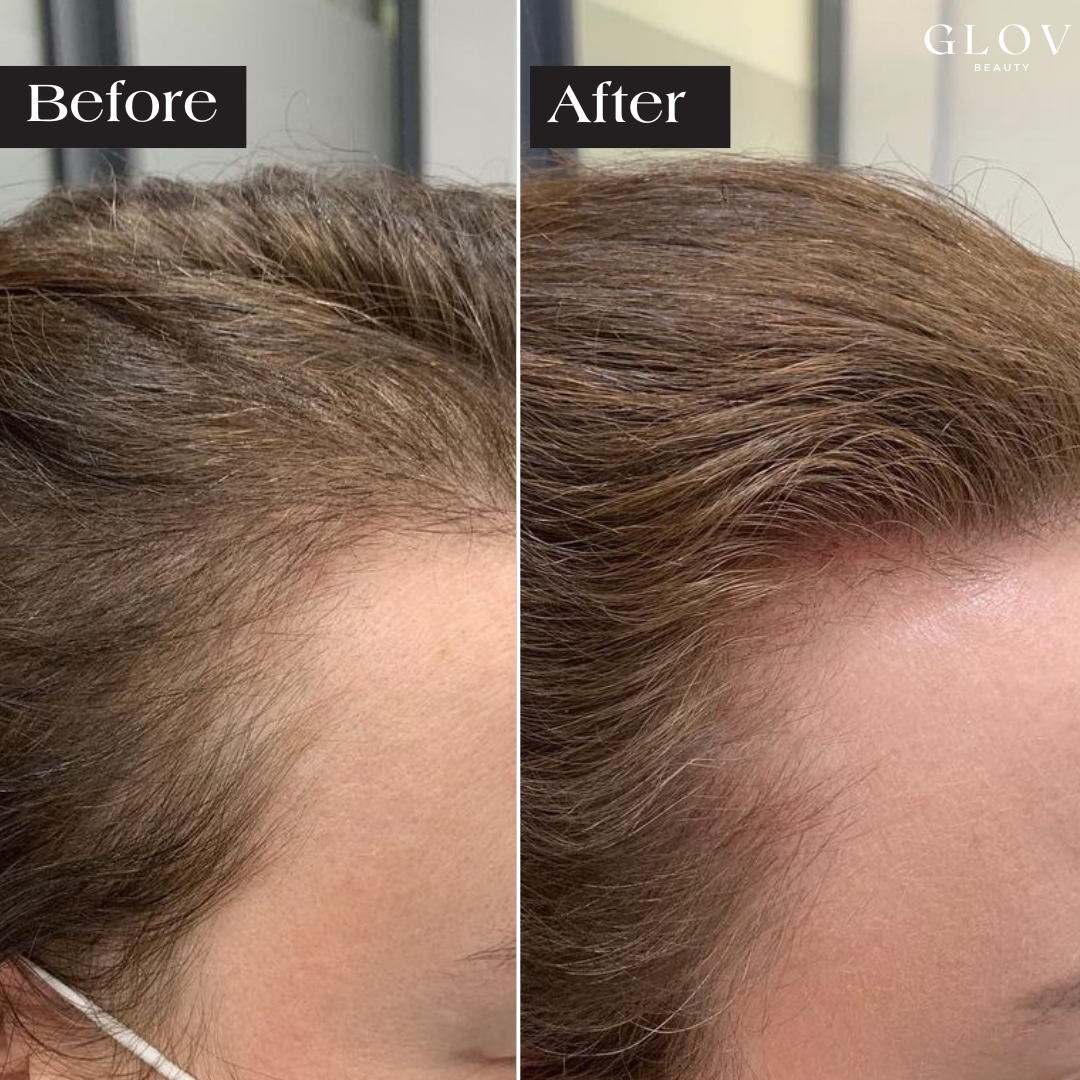 Nivah Hair Regrowth System
